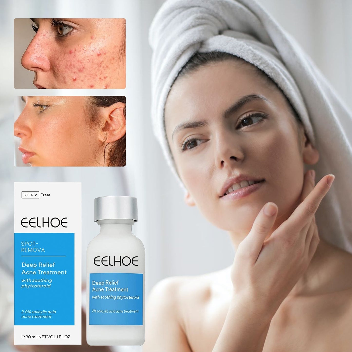 EELHOE™ Dark Spot and Acne Treatment Lotion