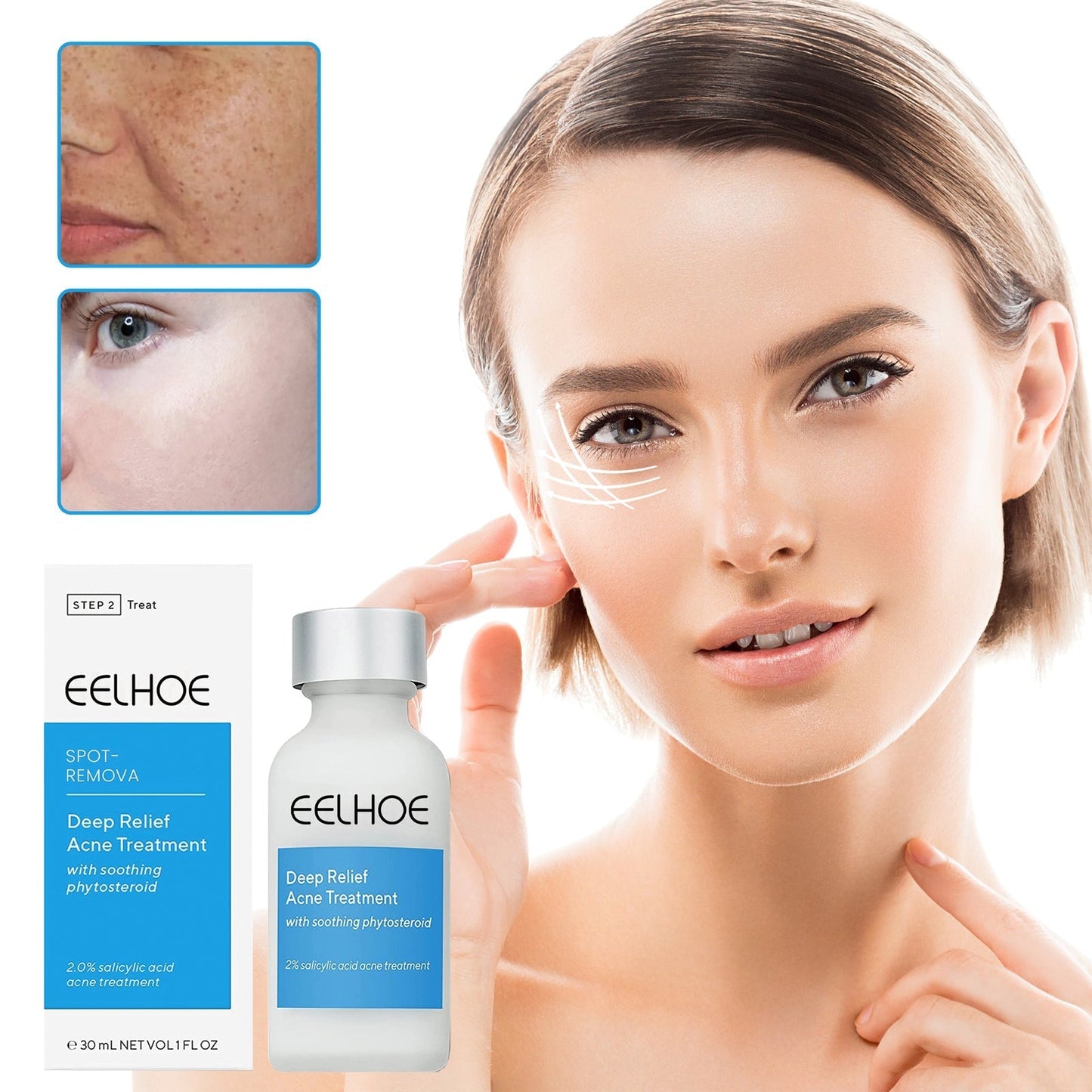 EELHOE™ Dark Spot and Acne Treatment Lotion